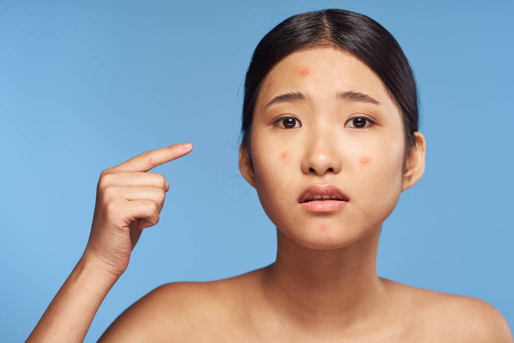 Skin consultation for spot and acne treatment at Sultan Beauty, Cardiff
